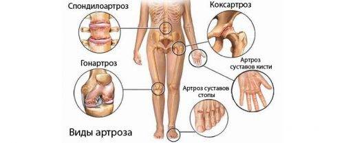 Виды артрозов по месту расположения Виды артрозов по месту расположения