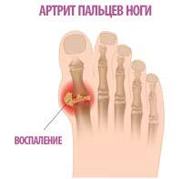 воспаление большого пальца ноги при артрите