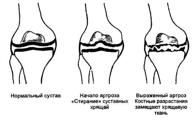 Классификация артроза рук