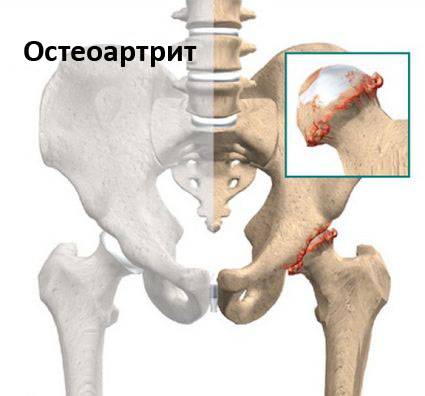 коксартроз тазобедренного сустава