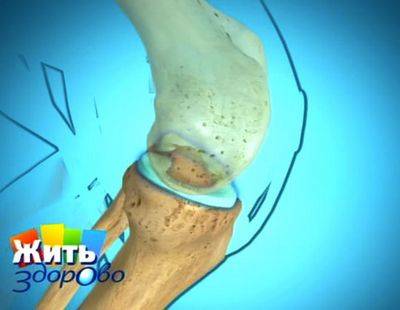 Боль суставах, народные рецепты артроз
