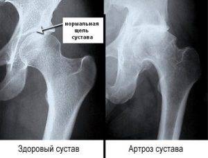 Изменения при коксартрозе на рентген снимке