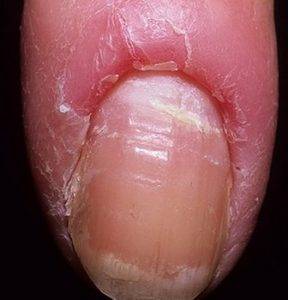 паронихия воспаление пальца