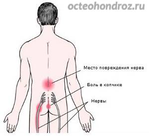 Поясничный остеохондроз