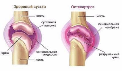 Здоровый сустав и сустав с остеартрозом