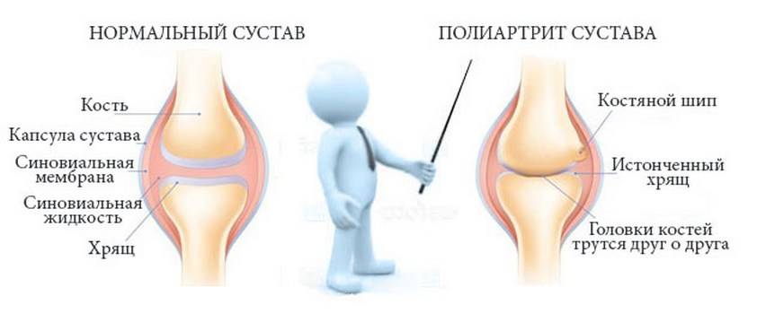 Ревматоидный полиартрит