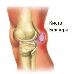 Киста под коленом