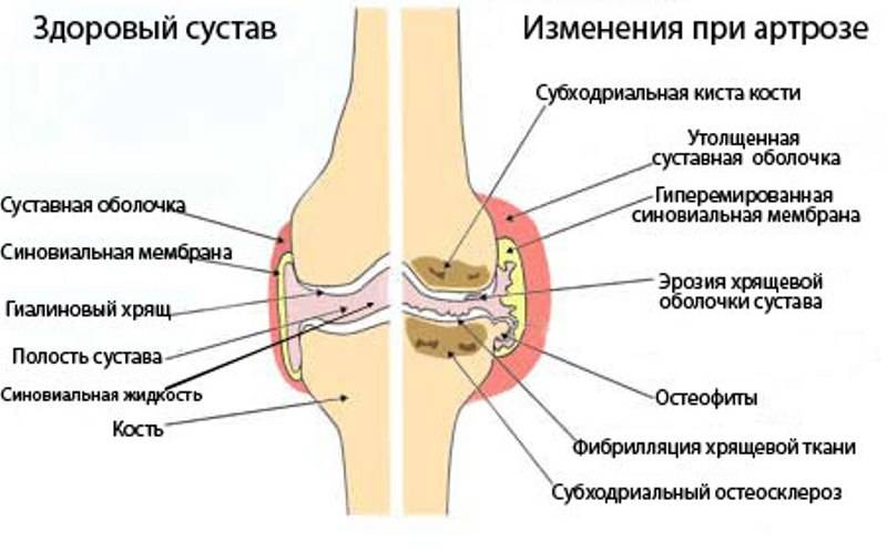 Артроз плечевого сустава