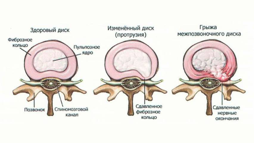 Питание при заболеваниях суставов