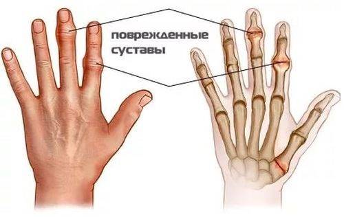 Артрит кисти