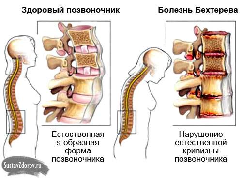болезнь Бехтерева у женщин (поражение позвоночника)