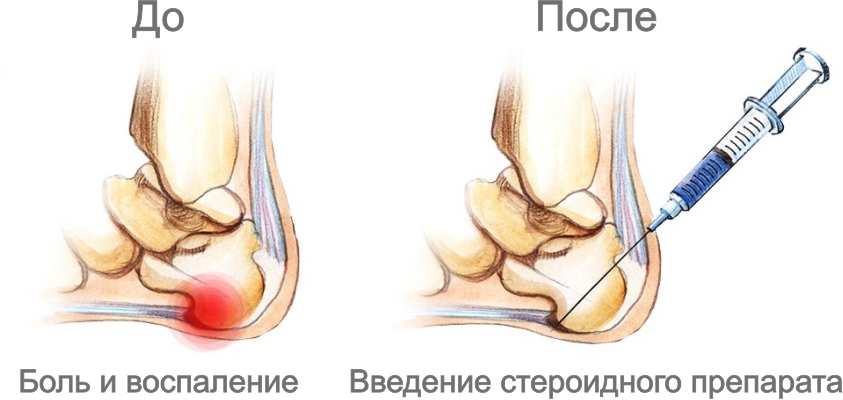 Проведение блокады снимает боль и воспаление