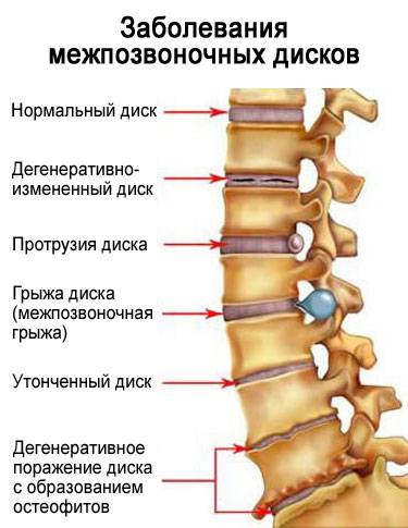 Развитие остеохондроза