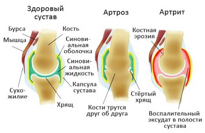 Здоровый и пораженные артритом и артрозом суставы Разница артроза от артрита