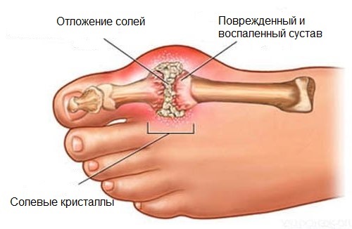 Отложение солей на пальцах ног