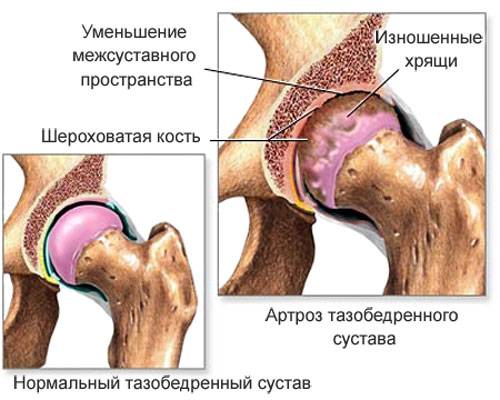 артроз тазобедренного сустава