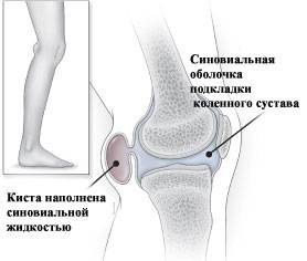Иллюстрация строения кисты