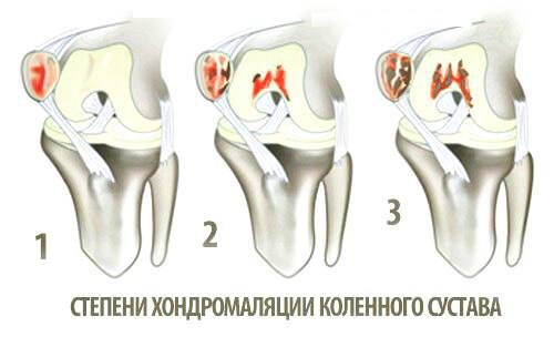 Терафлекс при артрозе коленного сустава