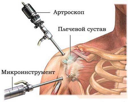 артроскопия артроскопия