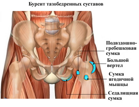 Вертельный бурсит Вертельный бурсит