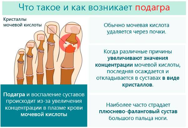 Подагра Что такое подагра