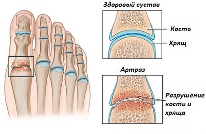 Артроз суставов стопы Артроз стопы