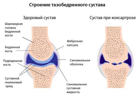 Механизм развития коксартроза