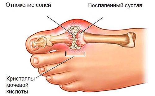 Излишек соли провоцирует болезнь