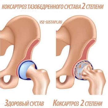 коксартроз тазобедренного сустава 2 степени сравнение
