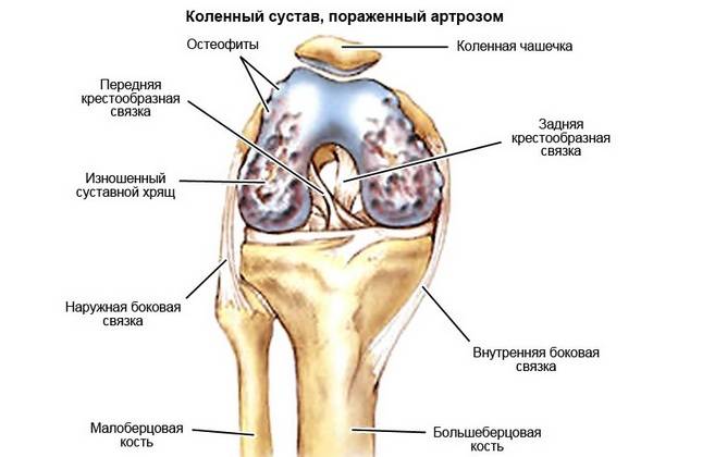 Артроз коленного сустава
