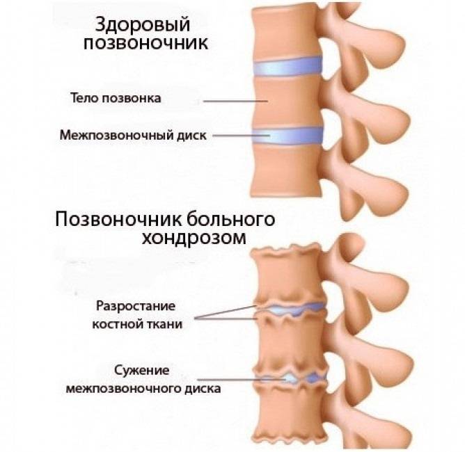 Грудной хондроз