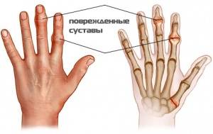 Ревматизм пальцев рук