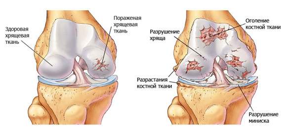 osteoartros