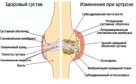 Препараты-хондропротекторы