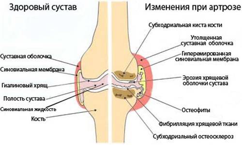 Факторы развития и проявления артроза пальцев рук Факторы развития и проявления артроза пальцев рук
