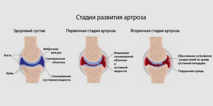 Развитие заболевания Стадии артроза