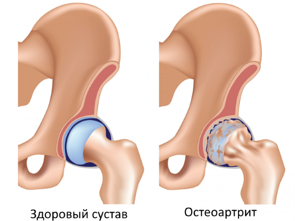Здоровый и большой сустав при остеоартрите