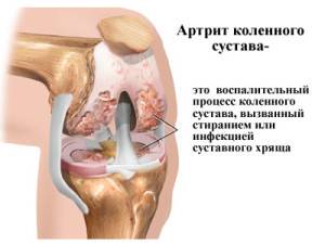 Артриз коленного сустава изнутри