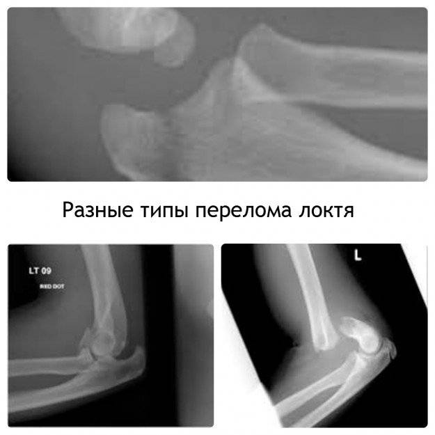 В зависимости от типа перелома, выбирается тактика лечения травмы локтя Ретгеновские снимки перелома локтя