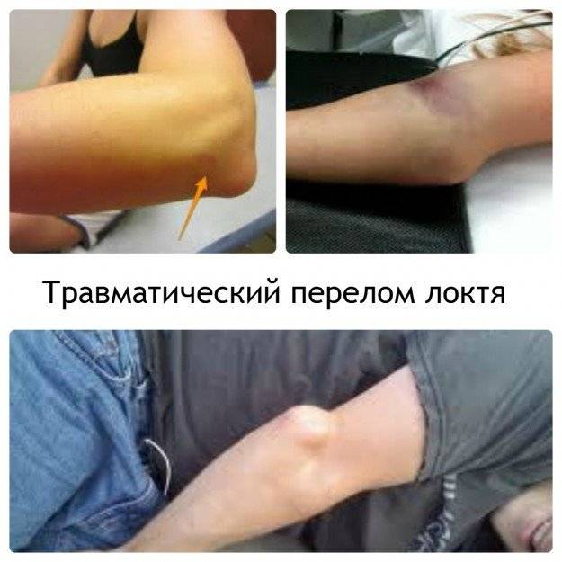 При травматическом переломе локтевого сустава наблюдаются отек и синяк вокруг локтя Сломанные локти