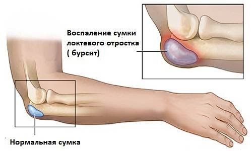 как лечить бурсит локтевого сустава