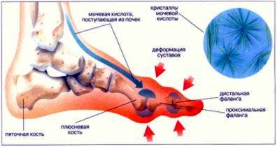 подагра на ногах лечение