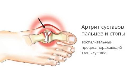 Причина первая: ушиб или перелом