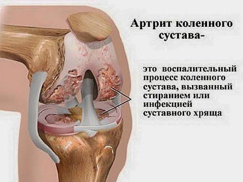 Артрит коленного сустава