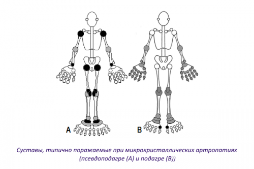 Суставы, типично поражаемые при подагре и псевдоподагре