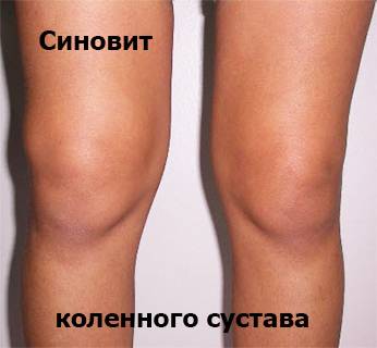 Так выглядит синовит коленного сустава Синовит коленного сустава