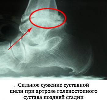 рентгеновский снимок артроза голеностопного сустава на поздней стадии