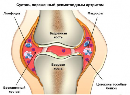 артрит колена артрит колена