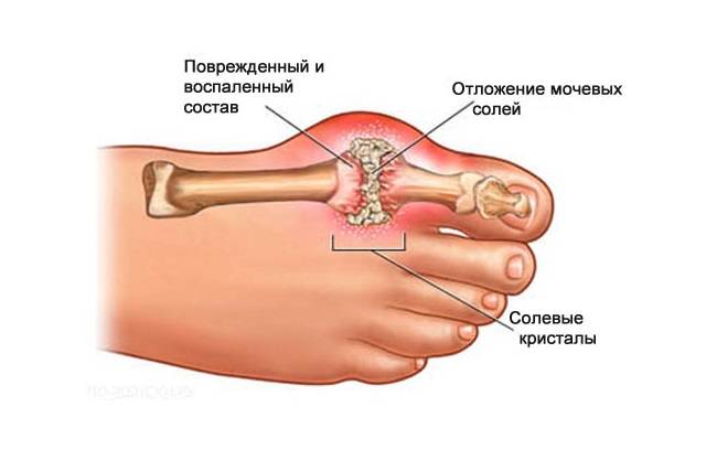 Развитие тофусов на суставе большого пальца ноги