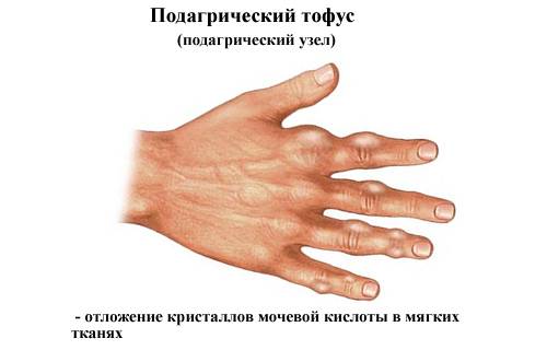 Подагрические тофусы в мягких тканях